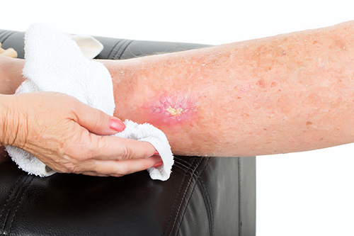 Comparison Study of Bacterial Profile, Wound Healing, and Cost  Effectiveness in Pressure Injury Patients Using Treatment Honey Dressing  and Hydrogel | Jurnal Plastik Rekonstruksi