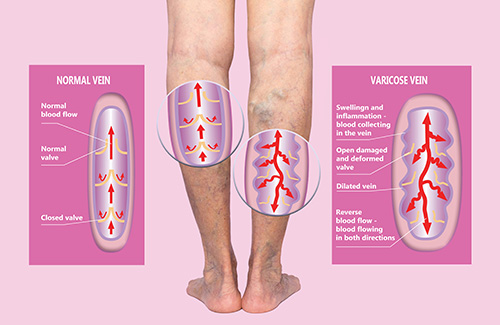 Varicose veins - Venous diseases - Compression - Indications